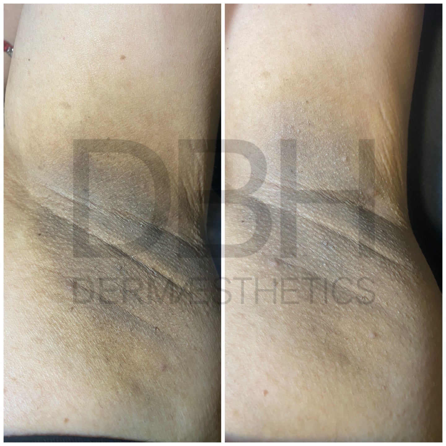 Intimate & Body Skin Discoloration Correction