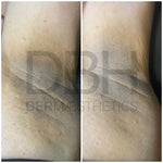 Intimate & Body Skin Discoloration Correction