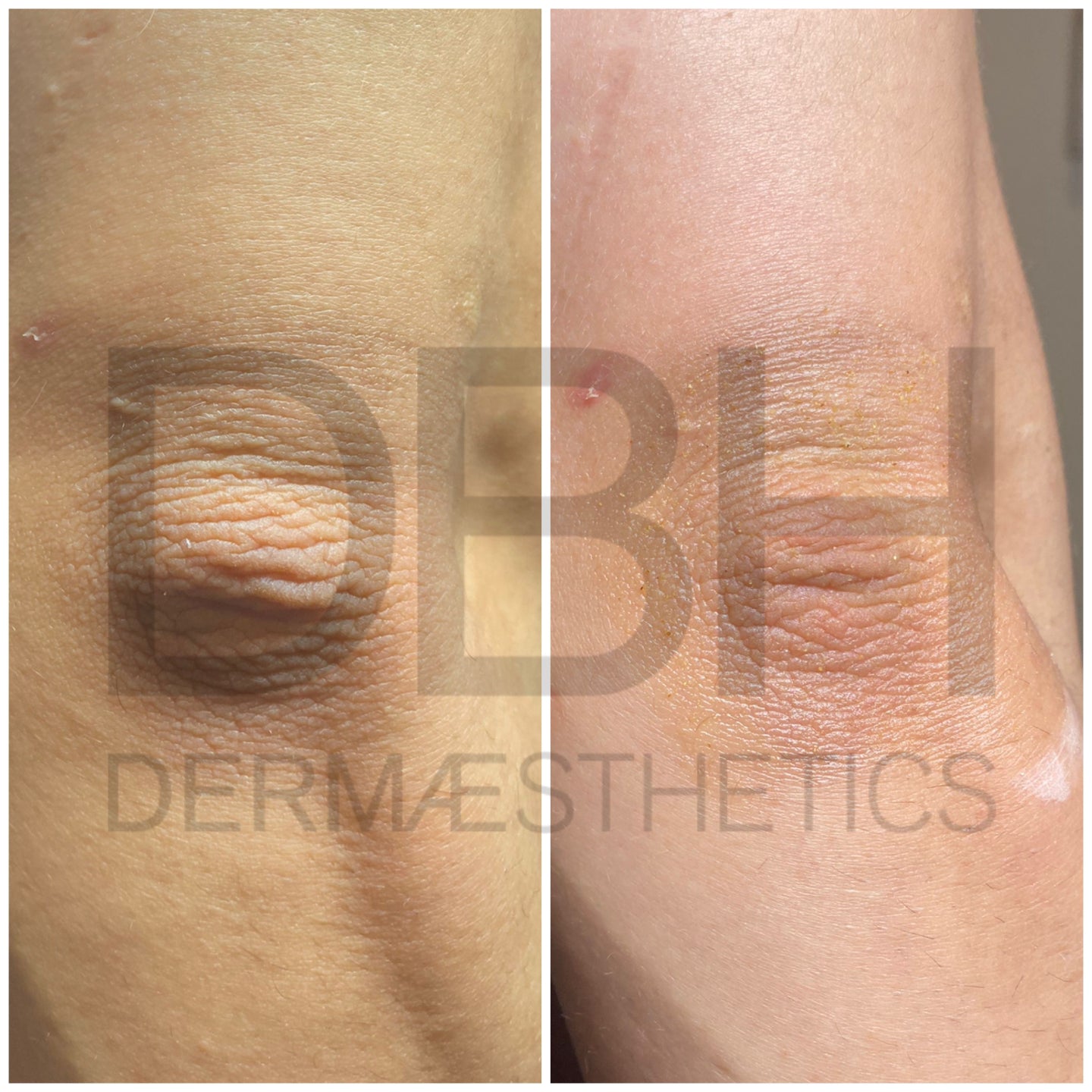 Intimate & Body Skin Discoloration Correction