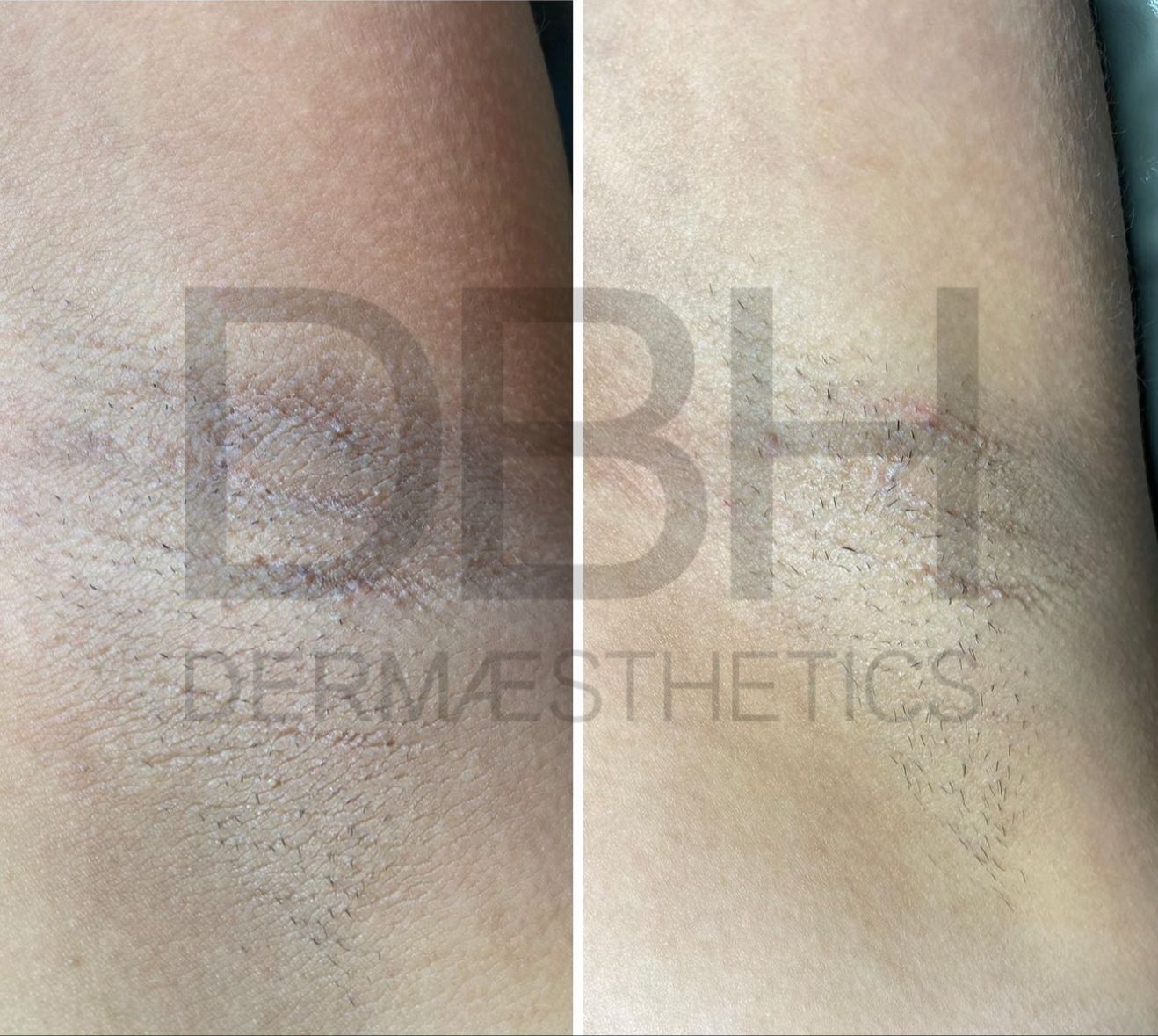 Intimate & Body Skin Discoloration Correction