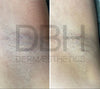 Intimate & Body Skin Discoloration Correction