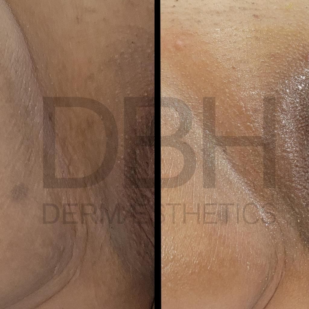 Intimate & Body Skin Discoloration Correction