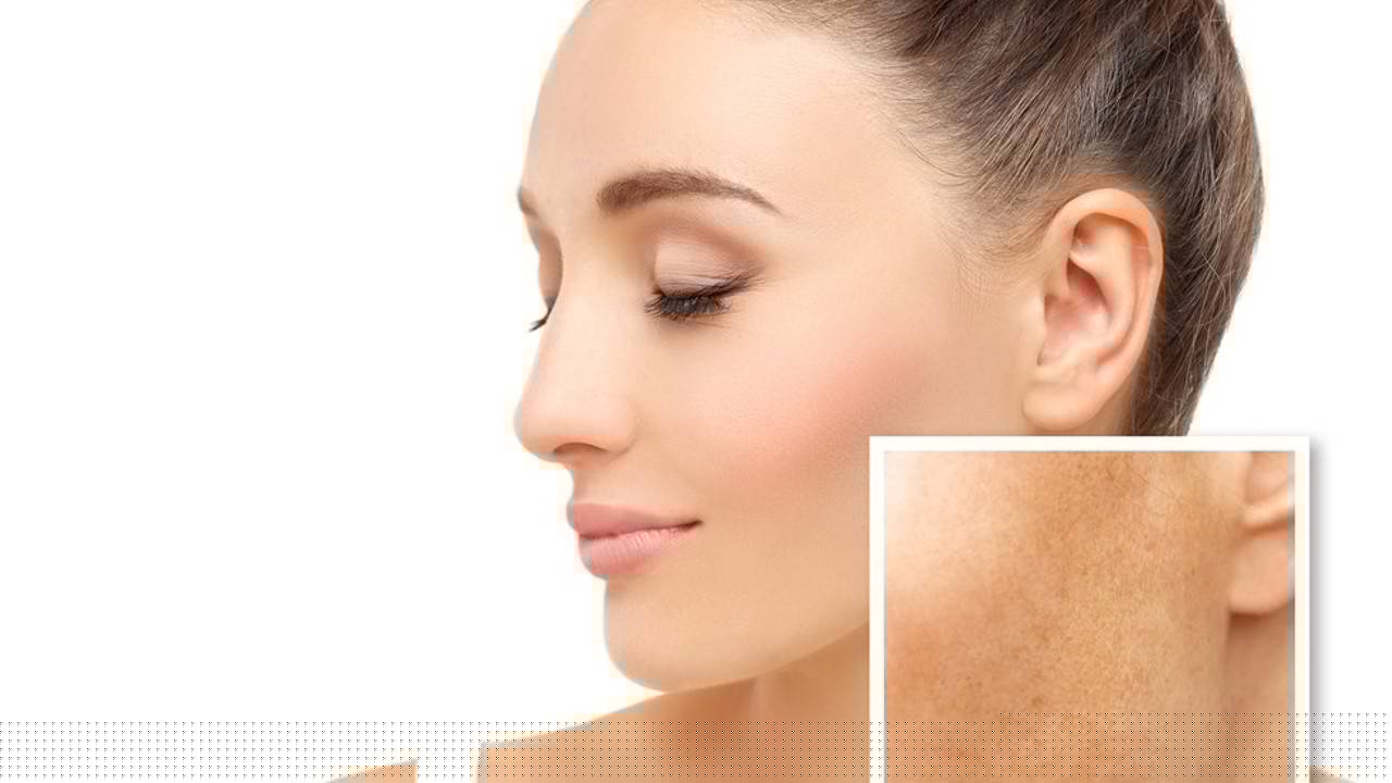 Focus Class: Acne