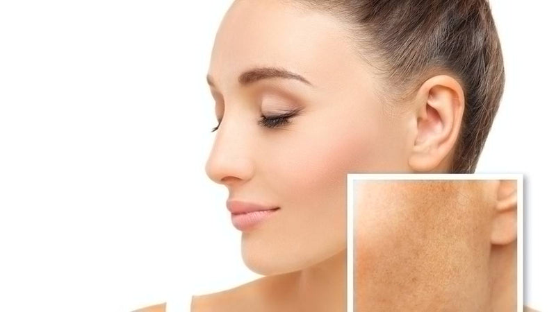 Focus Class: Acne