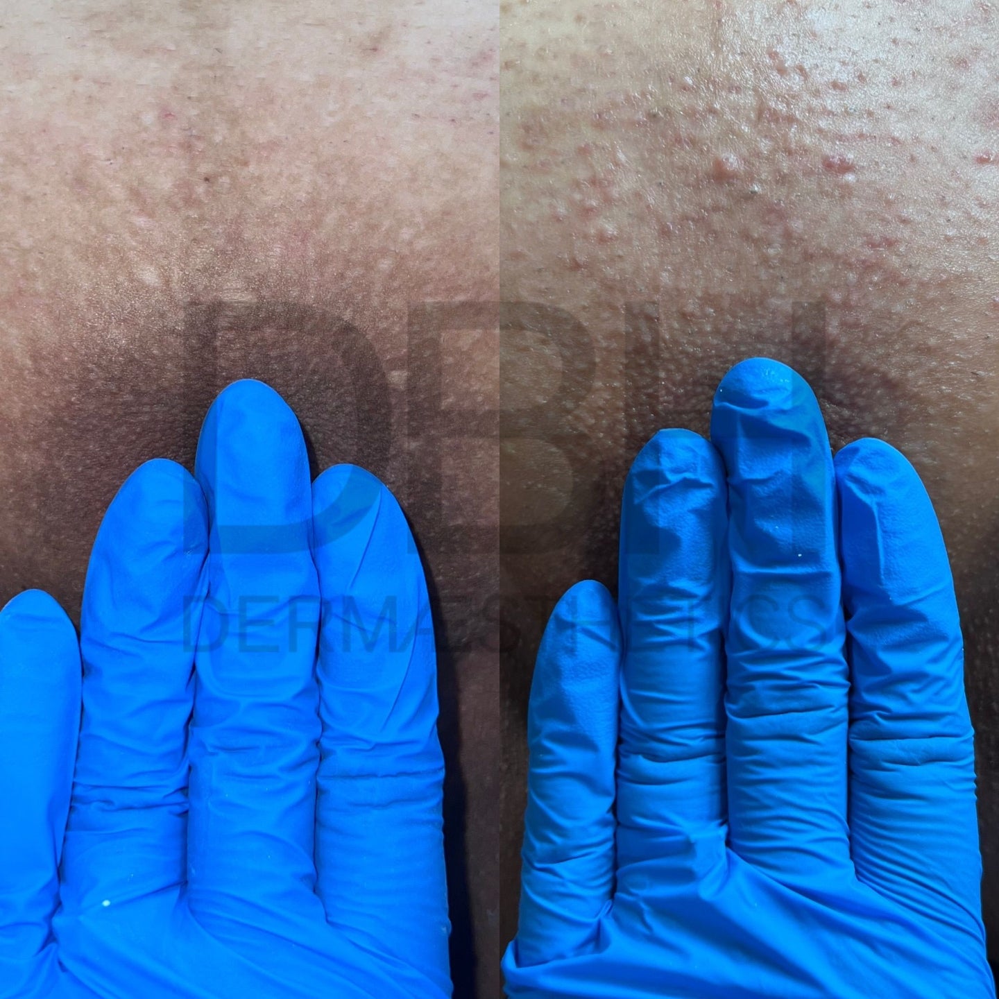 Intimate & Body Skin Discoloration Correction