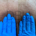 Intimate & Body Skin Discoloration Correction